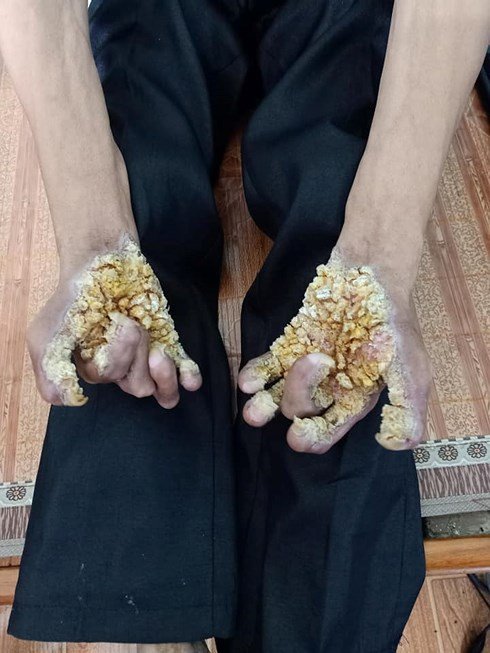 "Người cây" đầu tiên ở Việt Nam được phát hiện sau 40 năm mang bệnh - 2