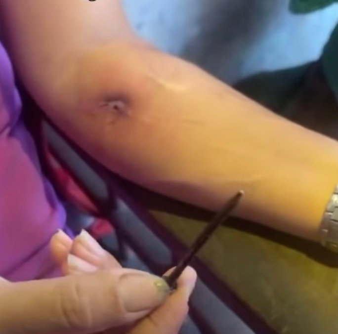 Thông tin một phụ nữ lấy 40 cây đinh từ vết thương trên cánh tay: Địa phương nắm tình hình - Ảnh 2. Thông tin một phụ nữ lấy 40 cây đinh từ vết thương trên cánh tay: Địa phương nắm tình hình - Ảnh 2.