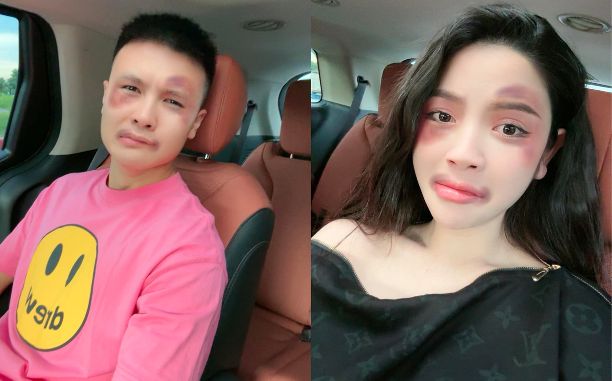 Chuyện gì xảy ra khi vợ chồng Quang Hải bị sưng tím mặt? Ảnh 1